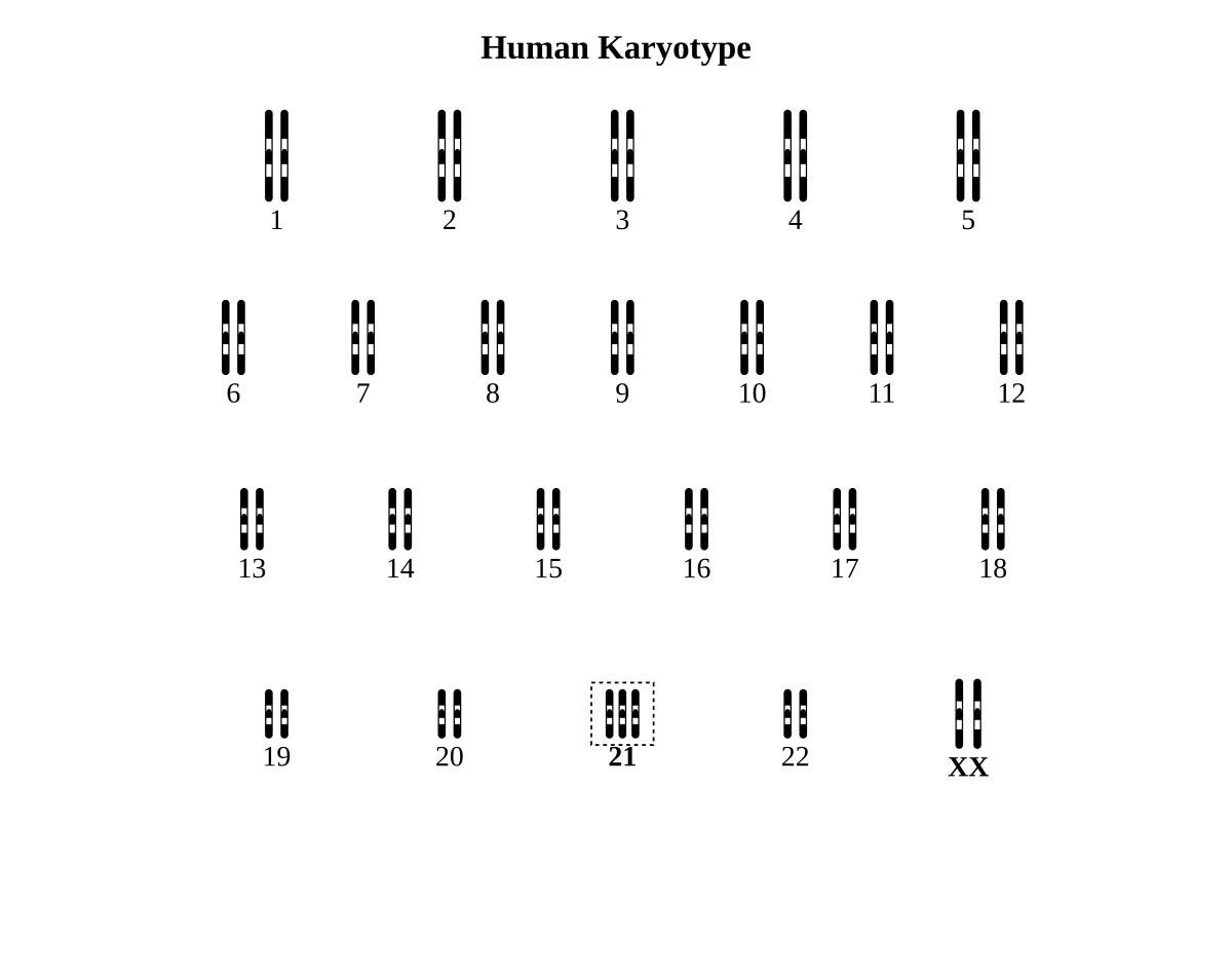 human karyotype showing 47 chromosomes arranged in numbered pairs; chromosome 21 is present in three copies; the sex chromosomes are XX.
